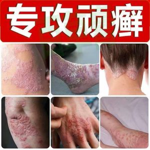 艾1贝儿狼毒癣克日本儿童湿疹癣藓根除癣的霸胆碱能性荨麻疹