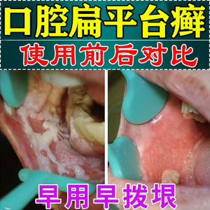 扁平苔藓口腔