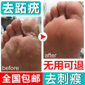 跖疣膏去除足部非日本病毒治手部脚疣点肉刺药膏正品刺祛瘊子神器