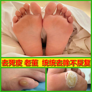 去老茧脚茧软化剂脚趾