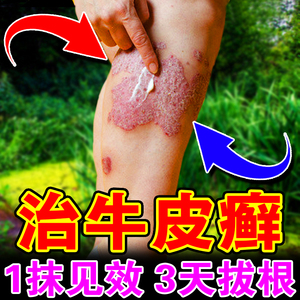 牛皮癣特效药膏银屑湿疹皮肤病专用苗癣王皮肤瘙痒银屑癣外用药膏