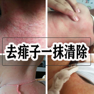 热痱子粉去痱止痒