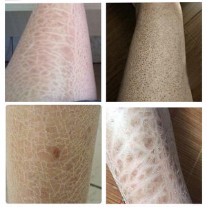 祛鱼鳞皮肤去小腿蛇皮克星病腿上干燥起皮除腿部毛囊角质化手臂治