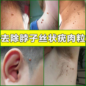 祛瘊子皮赘去除膏脖子上长小肉粒疙瘩丝状疣颈部瘤一抹无忧专用药