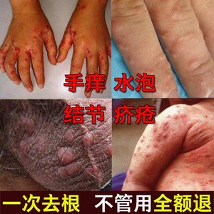 疥疮药结节一扫光特效干疮膏止痒外用去根抗真菌感染外用螨虫人用