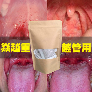 慢性咽炎茶咽喉炎化痰异物感滤泡增生治疗特效喷剂神器清咽中药茶