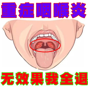 咽炎慢性咽炎除根咽喉炎根治茶咽喉异物感滤泡增生扁桃体发炎药茶