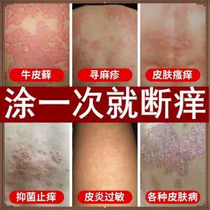 牛皮癣鲜银屑病股藓手足头皮癣水泡湿疹止痒去根皮肤专用治疗药