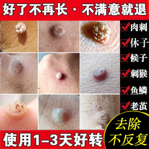 治瘊子祛刺猴去鱼鳞痣手足部猴子肉粒疙瘩去除正品脚上肉刺去除膏