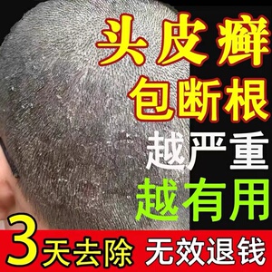 头皮癣专用药膏治疗牛皮癣银屑病真菌感染外用去头皮屑癣藓特效药