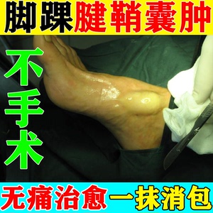 脚踝腱鞘囊肿手腕手指脚趾关节腱鞘鼓包疼痛专用药腱鞘炎腱消炎膏
