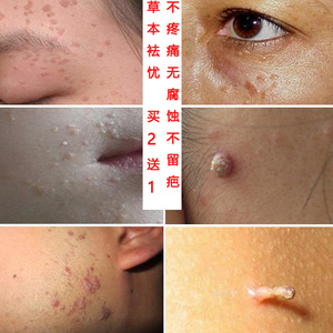 草本克疣霜去除脸部脖子丝状疣扁平尤手寻常忧肉刺猴子疣克舒软膏
