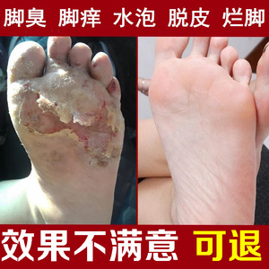 脚气喷剂止痒脱皮水泡型烂脚丫真菌感染脚臭脚痒脚气药足光粉