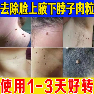 祛瘊子脖子上长小肉粒疙瘩点肉痣凸痣肉瘤腋下皮赘猴子药去除神器