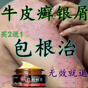 拔毒断癣王专治疗牛皮癣银屑病外用皮肤止痒去根无激素特效中药膏