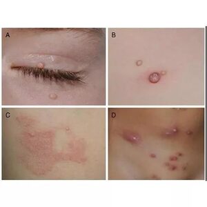 儿童传染性软疣儿童宝宝大人病毒性软疣水猴子软尤水瘊子状瘊疣软