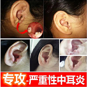 中耳炎专用药治疗烂耳朵流脓水发炎止痒人用药膏可除根消炎滴耳液