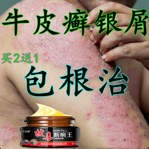 拔毒断癣王专治疗牛皮癣银屑皮肤瘙痒湿疹止痒去根无激素外用药膏