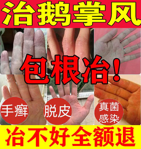 手癣膏治疗手足藓鲜真菌感染汗孢疹脱皮干裂水泡止痒鹅掌风中药膏