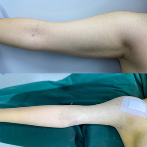 蝴蝶臂瘦手臂快速贴