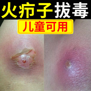 拔脓贴拔毒膏