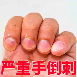 消刺油护手指甲营养油指缘油指缝儿童防倒刺修复去脱皮肉刺护理液
