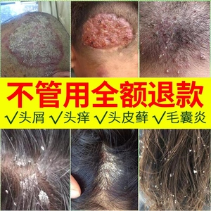 头皮癣药膏