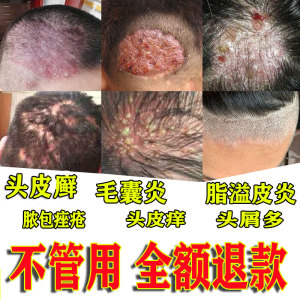 00王波勇淘宝李氏百草膏头癣头皮癣专用药膏头皮屑癣脂溢性皮炎去