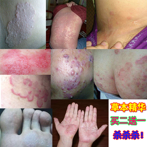 特效皮肤止痒草本乳膏大腿内侧痒阴囊外阴私处牛皮屁股藓痒软膏灵