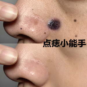 901059人付款淘宝去痣祛痣点痣膏正品取痣除痣黑痣黑点雀斑祛斑点痣