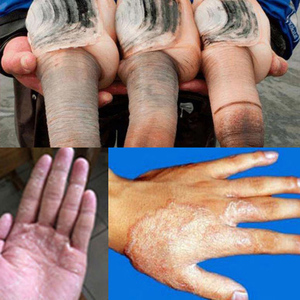 足癣膏真菌感染脱皮干裂特效手足水泡病止痒皮肤成人抑菌外用草本
