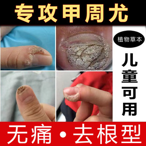甲周疣专用药儿童甲沟尤去甲下疣膏甲旁手指长疣趾疣去手足疣指甲