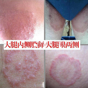 正品vg软膏日本原装牛皮美孚美浮特皮肤抗菌液官网疗霉舒凝胶止痒