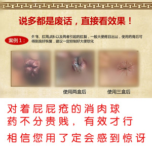 肛门瘙痒痔疮膏