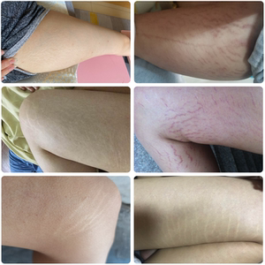 去除肥胖纹生长纹销除大腿学生淡化修复妊娠纹产后紧致御之棠纹霜