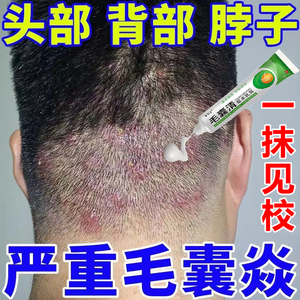 头皮毛囊炎专用药头皮有红疙瘩身上起痘痘前胸后背长痘除螨止痒膏