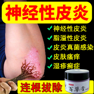 治疗神经性皮炎去根除瘙痒顽固过敏湿疹脂溢性头皮手面部外用药膏