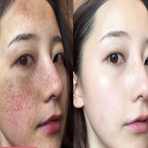 氢醌霜分解黑色素软膏祛斑霜祛黄褐斑雀斑色素沉着熊果苷乳膏正品