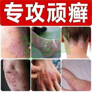 苗毒皮藓癣牛皮癣中药水去根初1肤堂祛癣搽剂泰国施1玛癣水顽皮癣