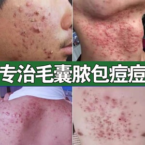 马拉色菌毛囊炎