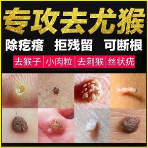 刺猴去除正品去脖子上的小肉粒疙瘩扁一抹平疣灵专用药祛痦子凸痣