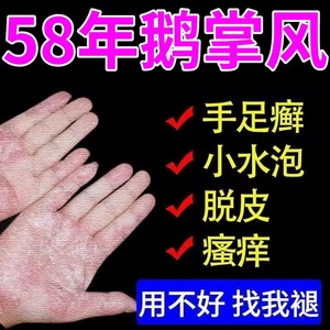 手癣真菌感染汗疱疹手脚脱皮干裂软膏藓长起水泡气专用鹅掌风药膏
