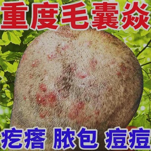 治头皮毛囊炎专用膏药头部脖子前胸后背私处马拉色菌痘痘中药酊疗