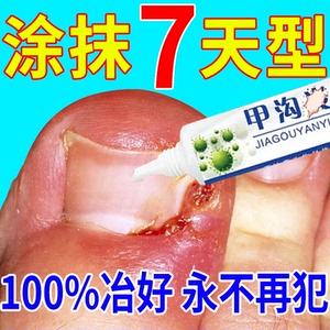 甲沟炎治疗专用药脚指甲往肉里长消炎软甲消肿去肉芽嵌甲矫正神器
