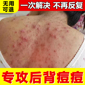 背上痘痘祛痘去印后背