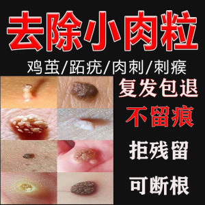 治瘊子的药点取手上长猴子肉粒瘤鱼鳞痣贴母肉刺猴跖疣头老鼠净