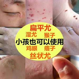 治疗水猴子的外用药膏女性男性脸上脖子大人小孩子儿童水瘊子软疣