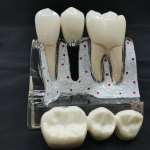 牙科种植模型口腔牙齿义齿修复4倍种植解说教学连桥牙冠医患沟通