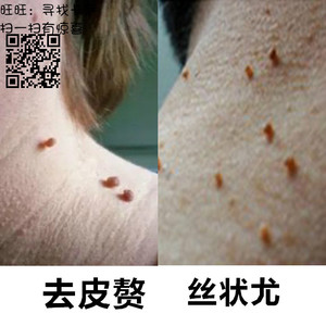 扁平疣丝状疣去除膏颈部脖子去皮赘肉粒疙瘩治肉刺瘊子去尤的药膏