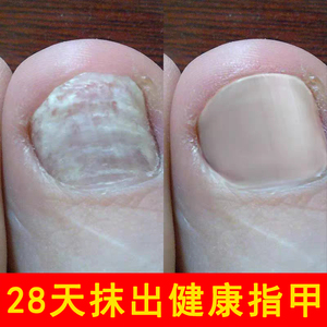指甲增厚脚趾甲黄黑白空甲肉分离修复手指甲发黄变厚康甲亮甲剥离